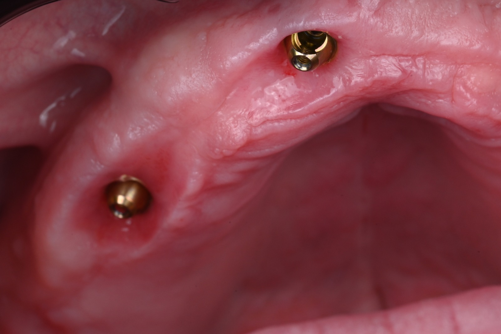 Keratinized peri-implant tissue matured around two multi-unit abutments in an edentulous arch, three months after PGTG